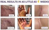 NEW Sealed Silicone Scar Gel Scar Cream - SPF 30 Advanced Scar Gel for Old and New Scars, BB: 03/29