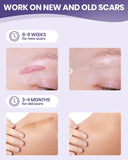 NEW Silicone Scar Sheets, Silicone Scar Tape, Non-Irritating Scar Removal Strips for Surgical Scars, Keloid, C-Section, Tummy Tuck, EXP: 11/11/2028