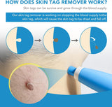 NEW Lerkely Skin Tag Remover, Stielwarts Removal Quick Kit, 2-in-1 Skin Tag Remover Kit for Micro to Large (2 mm-8 mm), Safe and Painless for All Body Parts