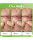 NEW Retails $61, Acotye Pimple Patch 60 Pieces Stern Pimple Patch With Niacinamide and Hyaluronic Acid Moisturizing Quick Healing of Acne Patch and Treatment of Acne Scars Remover (Ac-XX-04 s)