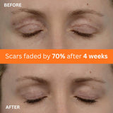 NEW Abera Scar Cream - Advanced Nano Formula for New and Old Scars - Effective for Keloids, Stretch Marks, Surgical Scars, and Acne Marks - Restores Smooth-Looking Skin (1 Box)