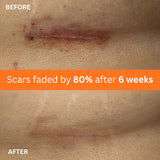 NEW Abera Scar Cream - Advanced Nano Formula for New and Old Scars - Effective for Keloids, Stretch Marks, Surgical Scars, and Acne Marks - Restores Smooth-Looking Skin (1 Box)