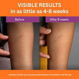 NEW Abera Scar Cream - Advanced Nano Formula for New and Old Scars - Effective for Keloids, Stretch Marks, Surgical Scars, and Acne Marks - Restores Smooth-Looking Skin (1 Box)