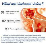 NEW Retails $40, Varicose Vein Cream - for Legs Reduces Spider Veins and Heaviness Anti Varicose Vein Soothing Leg Cream to Improve Blood Circulation Enhance Capillary Varicose Vein Repair Cream 20g, BB: 08/28