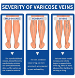 NEW Retails $40, Varicose Vein Cream - for Legs Reduces Spider Veins and Heaviness Anti Varicose Vein Soothing Leg Cream to Improve Blood Circulation Enhance Capillary Varicose Vein Repair Cream 20g, BB: 08/28