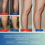 NEW Retails $40, Varicose Vein Cream - for Legs Reduces Spider Veins and Heaviness Anti Varicose Vein Soothing Leg Cream to Improve Blood Circulation Enhance Capillary Varicose Vein Repair Cream 20g, BB: 08/28